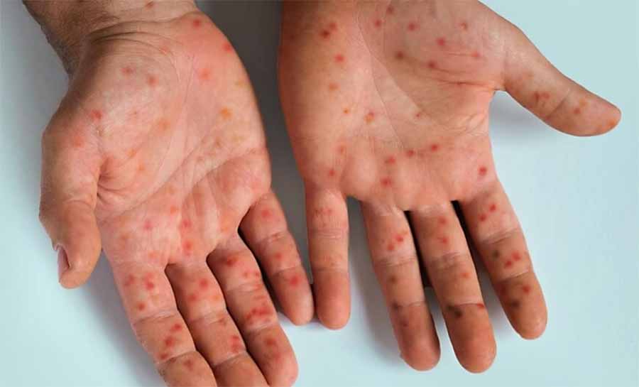 Acre registra primeiro caso de mpox em 2026 e acende alerta das autoridades de saúde